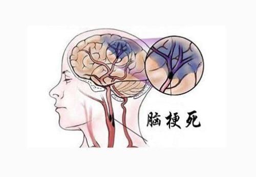脑梗塞.jpg 脑梗塞.jpg
